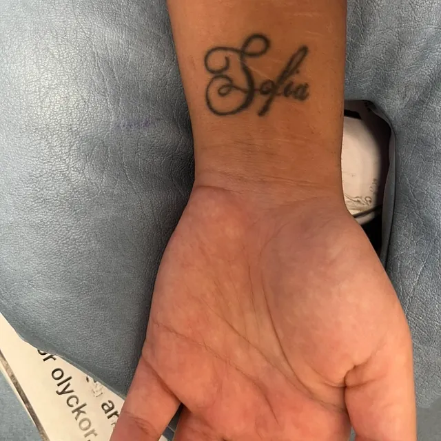 Tatueringsborttagning