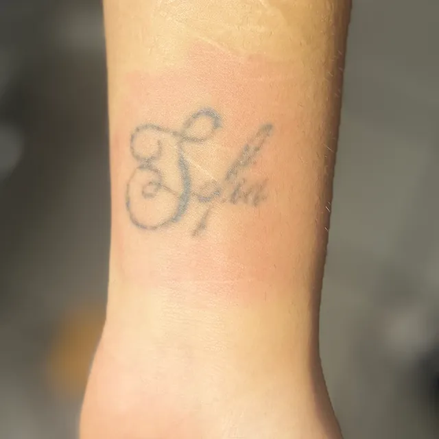 Tatueringsborttagning