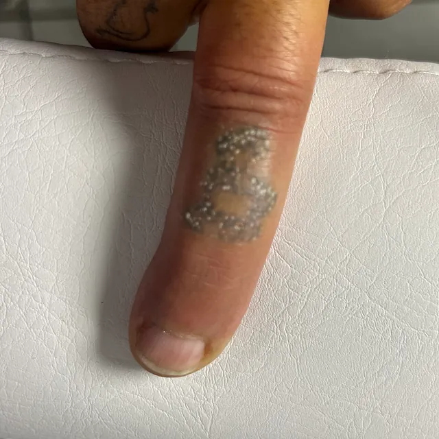 Tatueringsborttagning