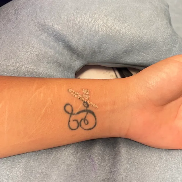 Tatueringsborttagning