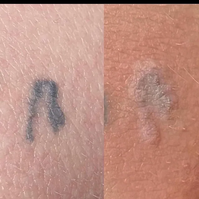Tatueringsborttagning