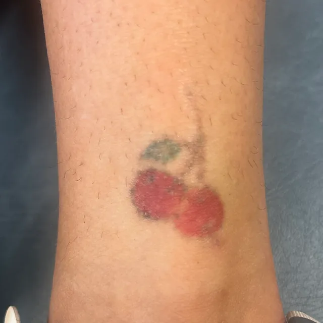 Tatueringsborttagning