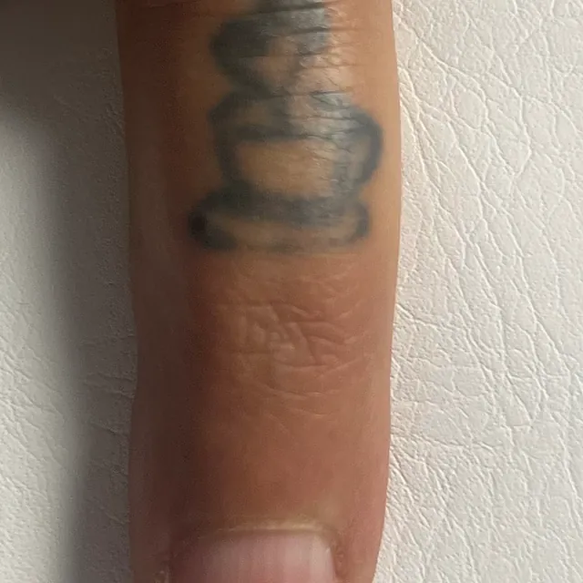 Tatueringsborttagning